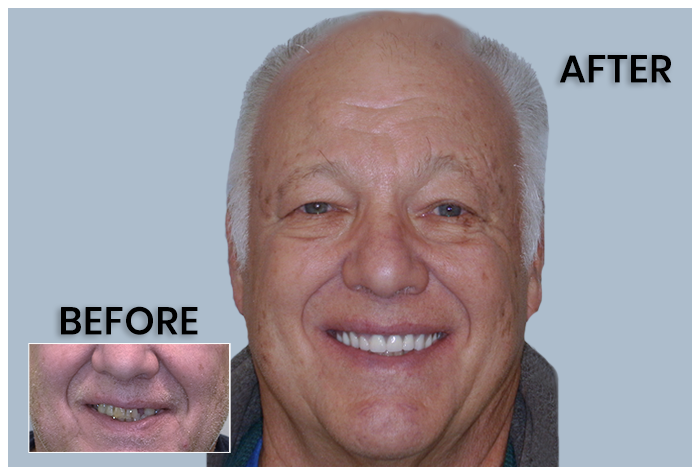Overdentures Before and After